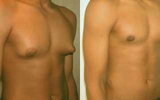 Гинекомастия у мужчин: фото до лечения и после