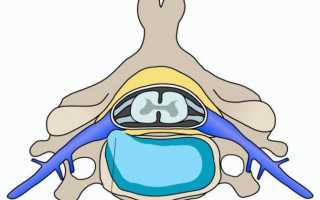 Что делать при диффузной протрузии дисков и что это такое