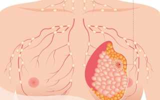 Как лечат саркому молочной железы в Израиле?