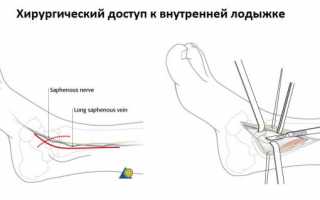 Особенности хирургического лечения перелома лодыжки