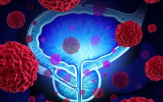 Рак простаты 3 степени и продолжительность жизни