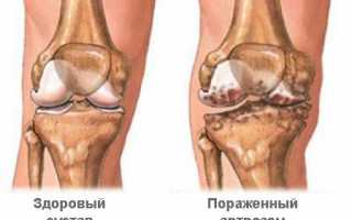 Принципы лечения артроза суставов: действенные препараты, физиотерапия, хирургическое вмешательство