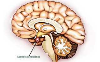 Аденома гипофиза: разновидности и методы лечения