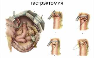 Лечение рака желудка в Израиле: есть ли шансы на жизнь?