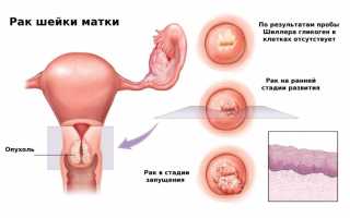 Саркома матки не приговор, если лечить ее в Израиле