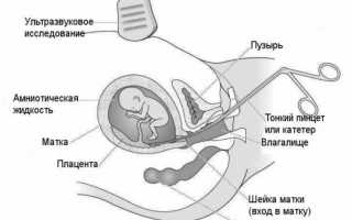 Биопсия ворсин хориона – путь к рождению здорового малыша