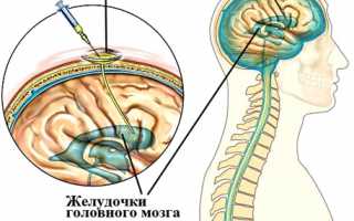 Имплантация резервуара Оммайя в Израиле