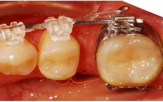 Ортодонтические кольца на зубы при брекетах