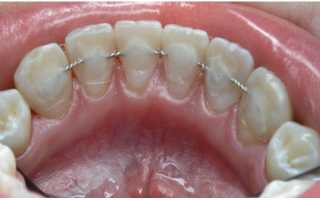 Как работают брекеты для зубов