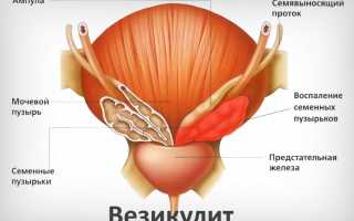 Везикулит как воспалительное заболевание мужской половой системы