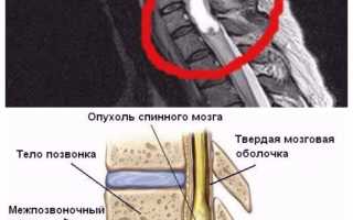 Опухоли спинного мозга: способы и эффективность лечения в Израиле