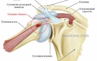 Как лечить патологии надостной мышцы плеча