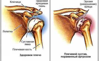 Артроз плечевого сустава: причины, симптомы, стадии и лечение