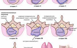 Рак позвоночника: причины, способы лечения и прогноз