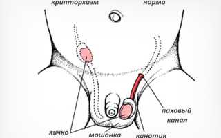Как распознать и нужно ли лечить крипторхизм у мальчиков?