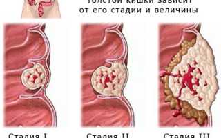 Рак кишечника: прогноз пятилетней выживаемости