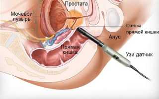 Как и зачем проводится УЗИ предстательной железы?