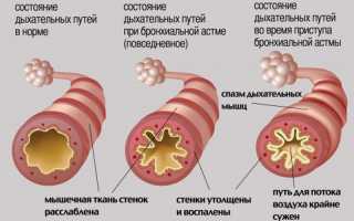 Курение при бронхиальной астме: последствия