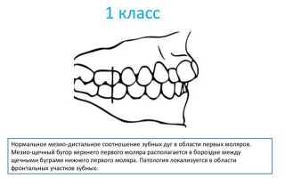 Классификации аномалий положения зубов в ортодонтии