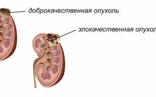 Онкоцитома почки: особенности и эффективность лечения в Израиле