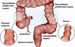 Геморрой и рак – как отличить на ранних стадиях патологии?