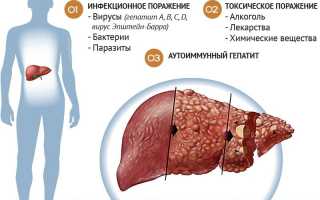 Алкогольная болезнь печени: симптомы