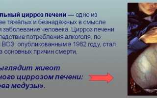 Алкогольный цирроз печени код 10 по МКБ