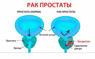 Успешное лечение урологических опухолей в Израиле