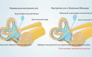 Синдром Меньера — что за заболевание, причины, симптомы, диагностика, лечение