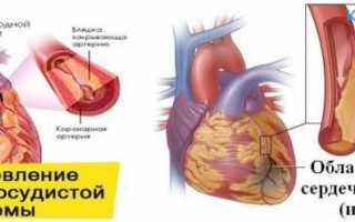 Что такое обширный инфаркт и его последствия