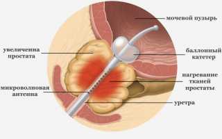 Хирургическое вмешательство при лечении аденомы простаты