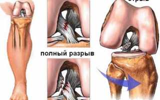 Почему хрустят колени и насколько это опасно